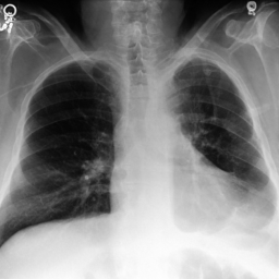 虛擬胸部 X 光 CXR 範例 1